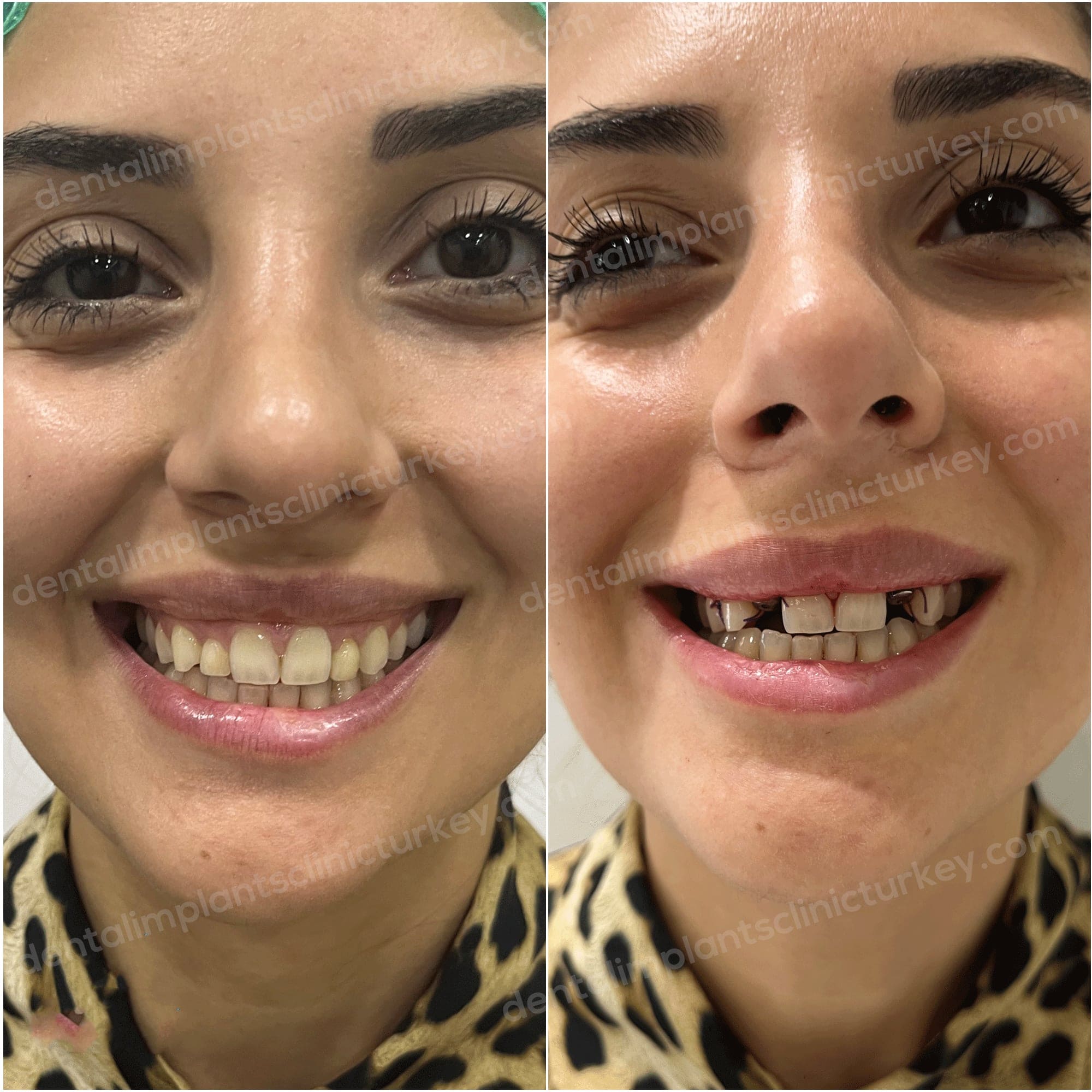 Dental Implants Before After Image
