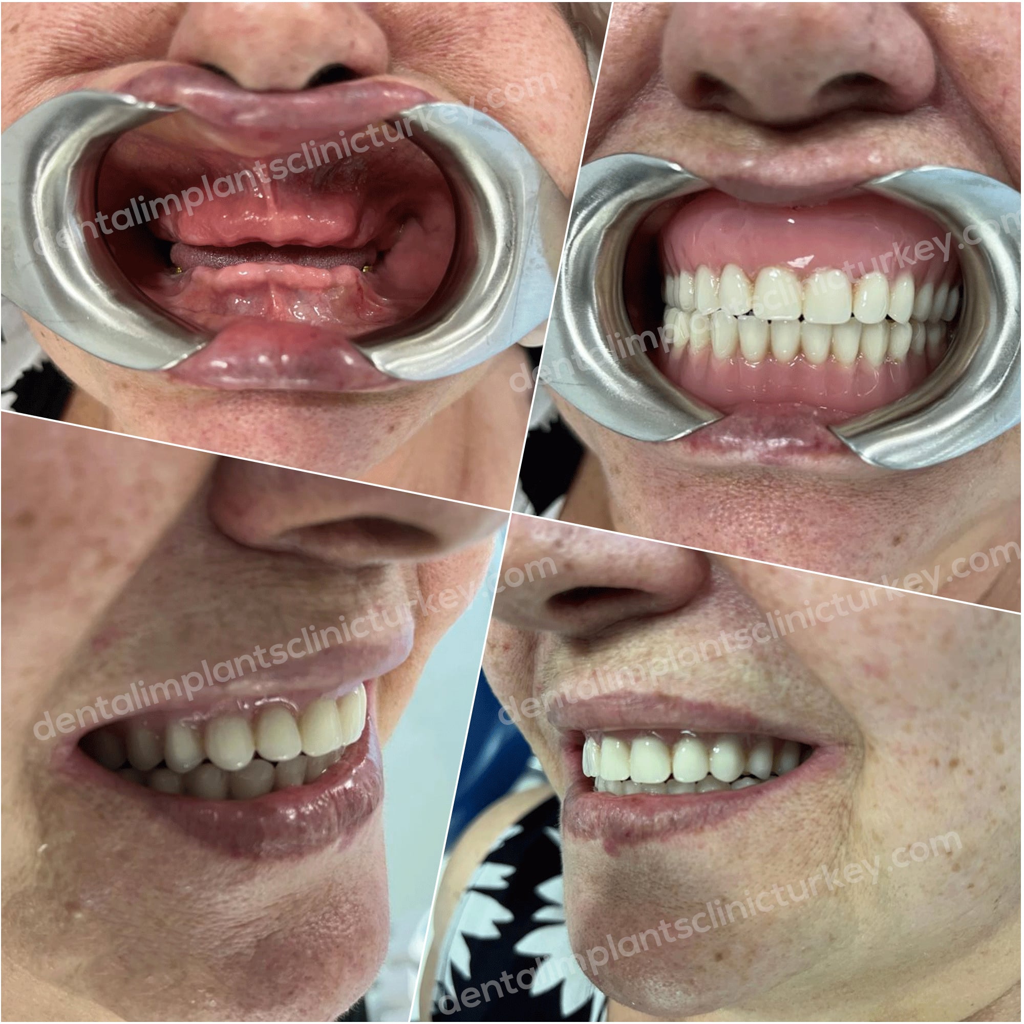 Full Mouth dental implants before after Image